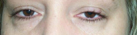 Both sides, left lower than right (asymmetric ptosis)