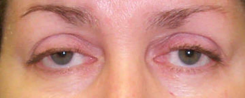 Both upper lids droop, partly covering the eyes