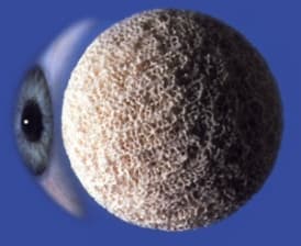 Porous orbital implant used in socket reconstruction