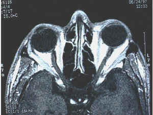 Axial view of orbital anatomy