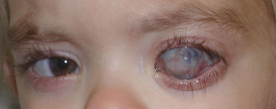 Anophthalmic reconstruction result, primary gaze