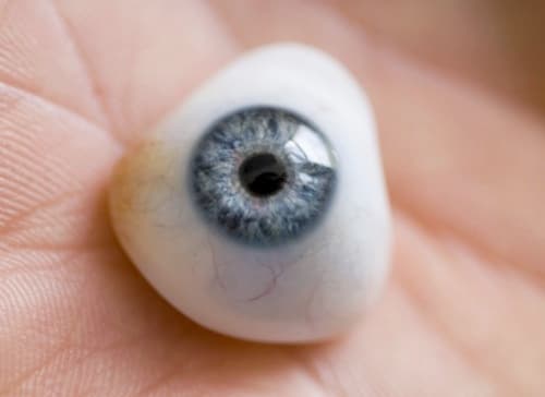 Custom ocular prosthesis result