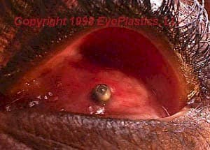 Integrated porous implant in vivo