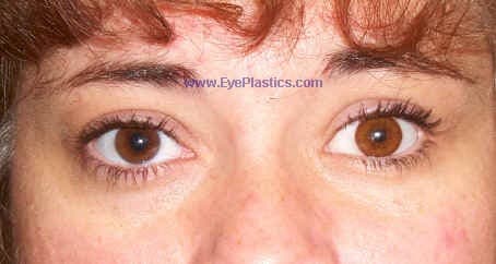 Long-term prosthetic result matching the fellow eye