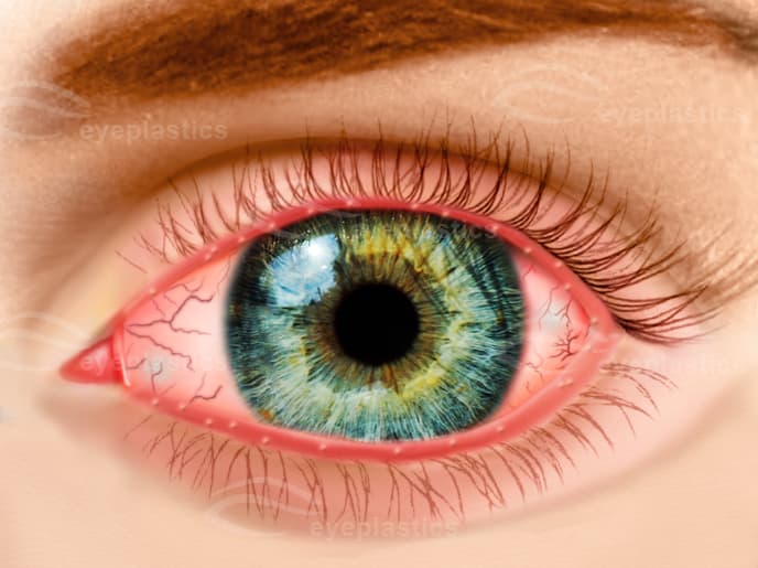 Clinical appearance of blepharitis: red, inflamed lid margins with conjunctival injection