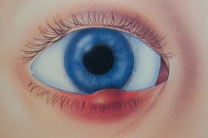 Chalazion — meibomian gland cyst complication of blepharitis