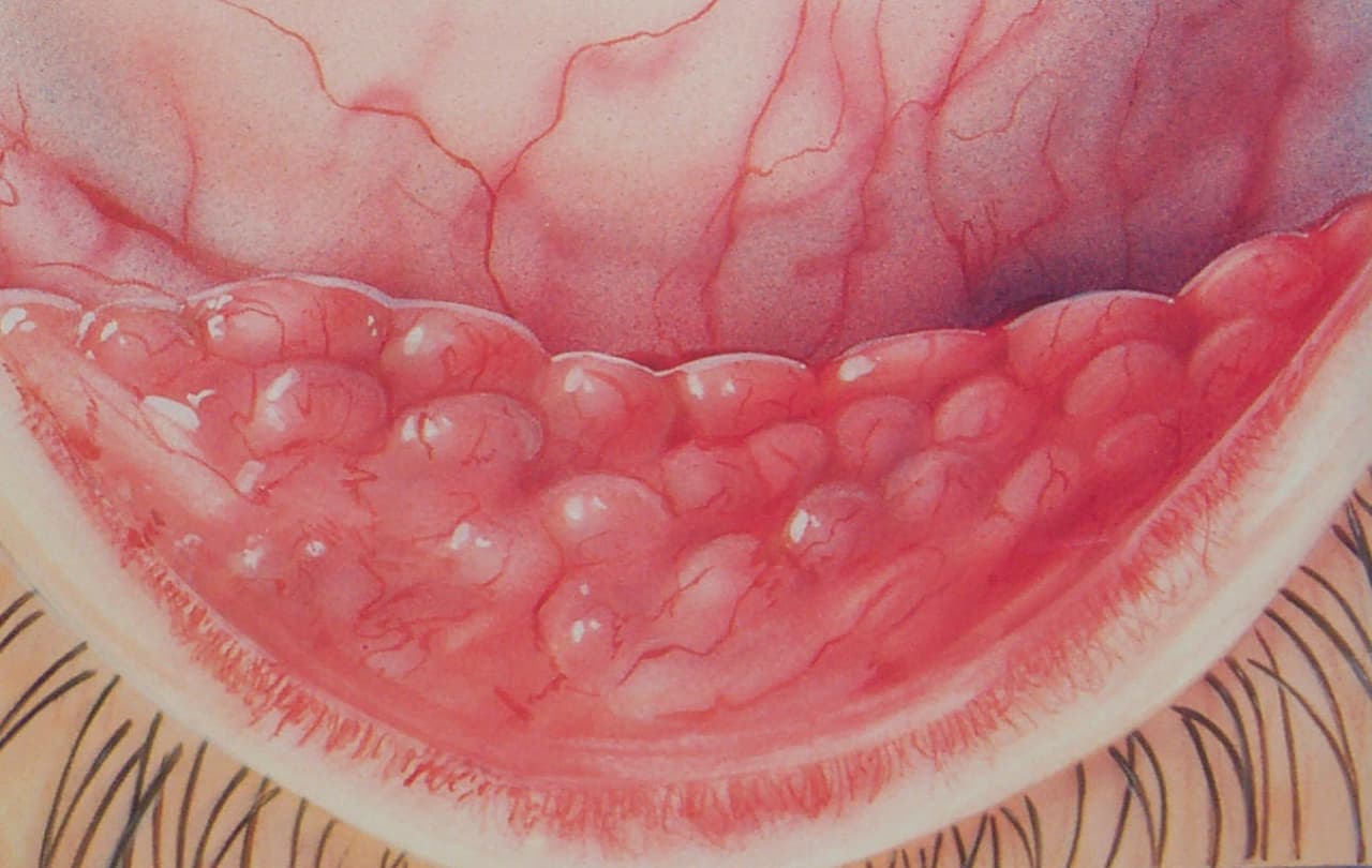 Viral conjunctivitis — differential diagnosis
