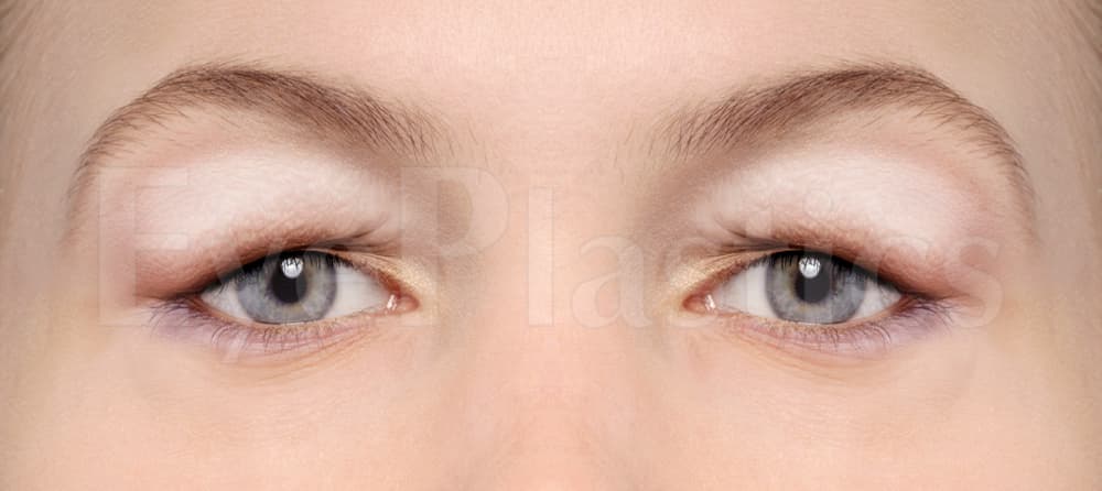 Upper eyelid blepharoplasty before and after