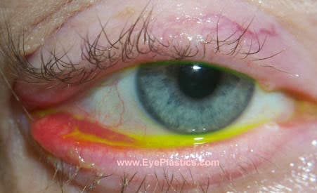 Cicatricial ectropion following lower eyelid surgery