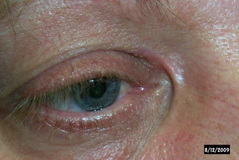Medial canthal web after eyelid surgery &mdash; vertical fold of skin across the inner corner