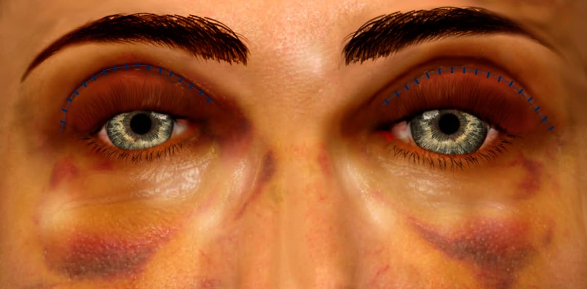 Upper blepharoplasty recovery at 1 week
