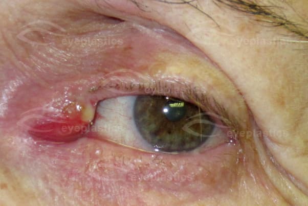 Canaliculitis of the upper canaliculus — left upper eyelid