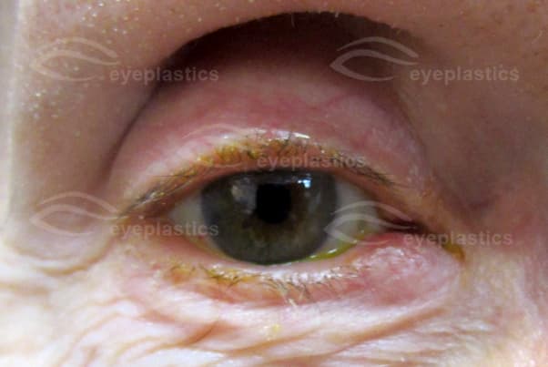 Canaliculitis of the right lower eyelid &mdash; erythema and swelling over the medial canaliculus