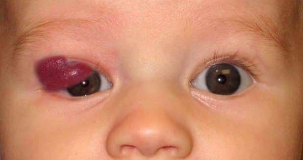 Capillary (strawberry) hemangioma involving the eyelid of an infant