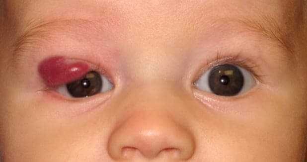 Same hemangioma one month after starting topical timolol