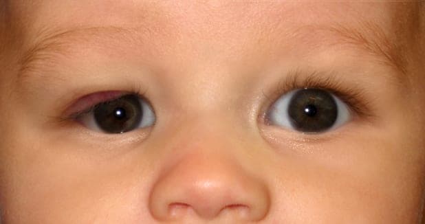 Near-complete involution of the hemangioma at fourteen months
