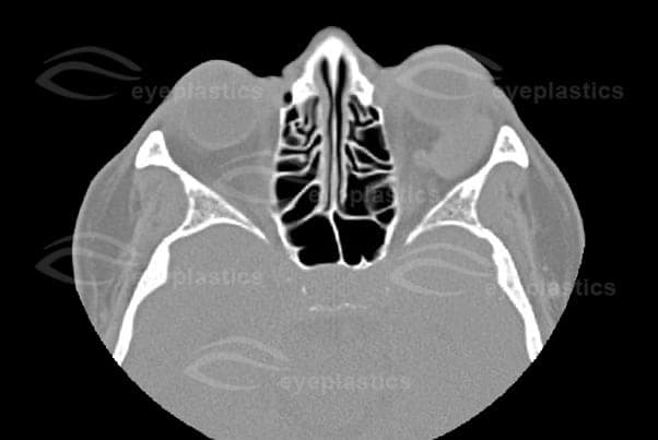 Axial CT of the same left orbital cavernous hemangioma