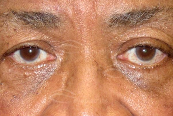 After surgical removal the left eye has receded to a normal position