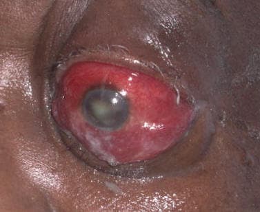 Orbital cellulitis with proptosis and restricted eye movement