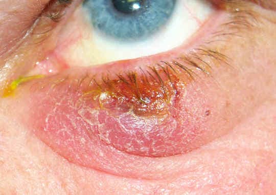 Chalazion clinical appearance