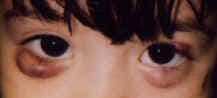 Chalazion in a child