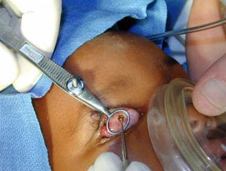 Chalazion incision and curettage procedure