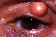 Chalazion — eyelid cyst