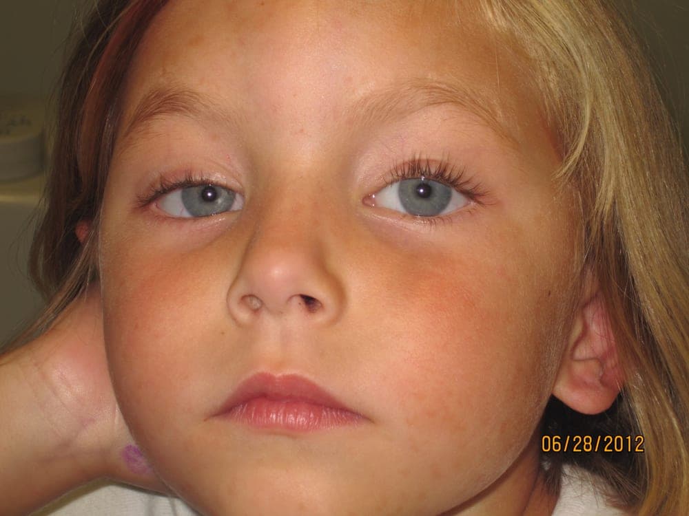 Child with congenital ptosis of one upper eyelid