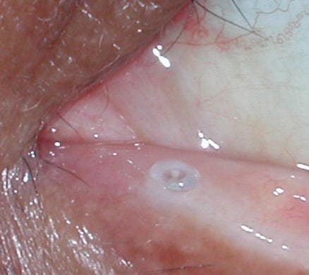 Punctal plug seated in the lower-eyelid punctum