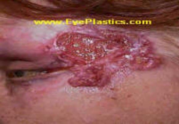 Basal cell carcinoma — a pearly nodule with rolled borders and fine surface vessels