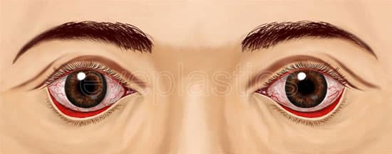 Clinical photograph of ectropion &mdash; lower eyelid turning outward