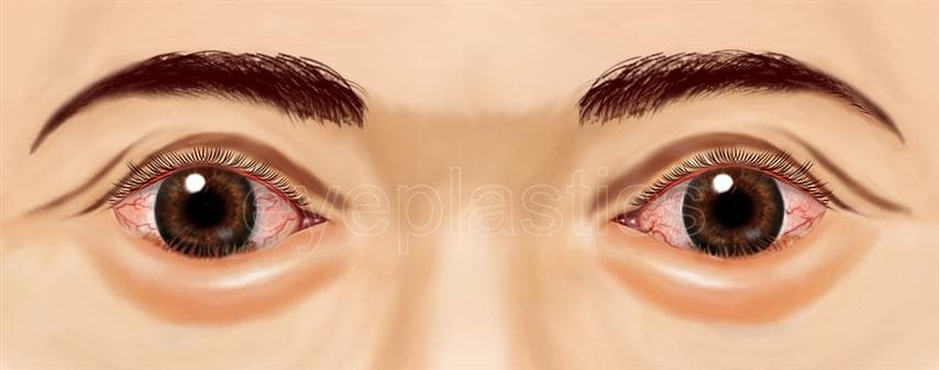 Clinical photograph of entropion &mdash; lower eyelid turning inward