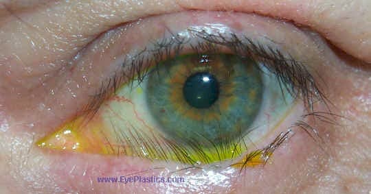 Clinical photograph of trichiasis &mdash; eyelashes rubbing on the cornea