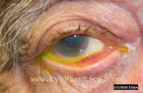 Ectropion &mdash; outward turning of the lower eyelid