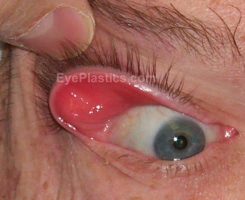 Easy eversion of the upper eyelid with only minimal upward traction — the hallmark sign of floppy eyelid syndrome