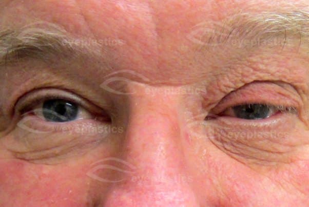 Floppy eyelid with associated upper-eyelid ptosis and lash ptosis