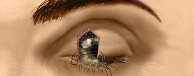 Wound closure shifting the upper eyelid nasally