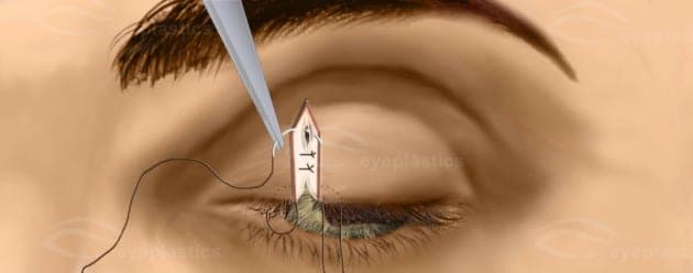 The tightened upper eyelid after wedge closure