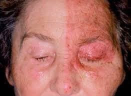Herpes zoster ophthalmicus &mdash; unilateral dermatomal rash with eyelid swelling
