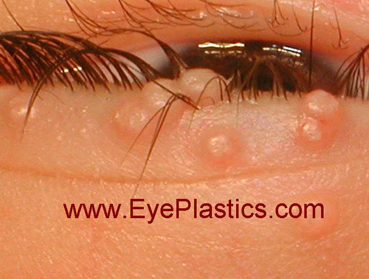 Molluscum contagiosum &mdash; close-up of eyelid papules