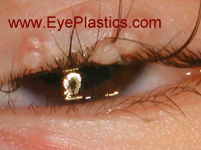 Molluscum contagiosum &mdash; periocular distribution