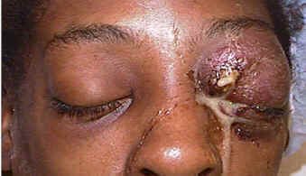 Orbital cellulitis &mdash; clinical photograph