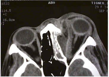 Orbital infection &mdash; CT imaging