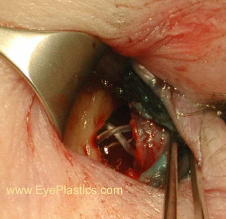 DCR surgery — exposure of the lacrimal sac region