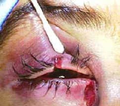 Canalicular laceration &mdash; medial eyelid laceration with canalicular involvement
