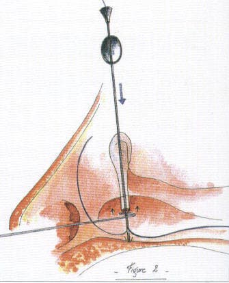 Silicone stent passed through the canalicular system