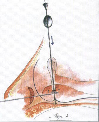 Completed canalicular repair over the stent