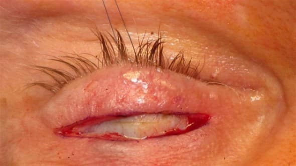 Eyelid crease incision during gold weight implantation surgery, tarsus exposed