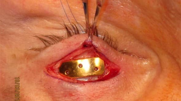 Gold weight positioned on the surface of the tarsus during eyelid surgery