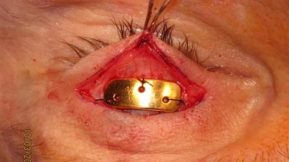 Gold weight sutured to the tarsus